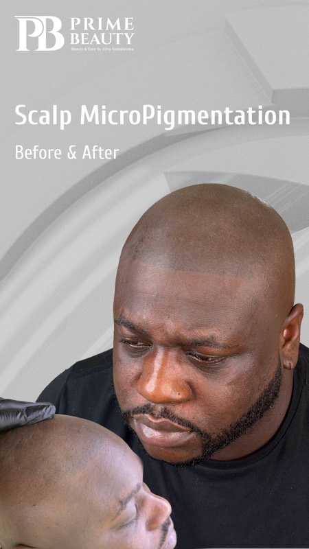Scalp micropigmentation before and after by Prime Beauty